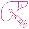 Laparoscopic Hydatid Liver Cyst Surgery icon