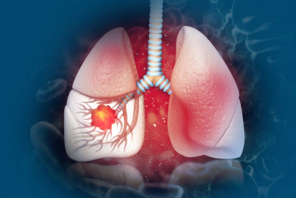 Lung Cancer- Causes,  Types, Diagnosis & Treatments