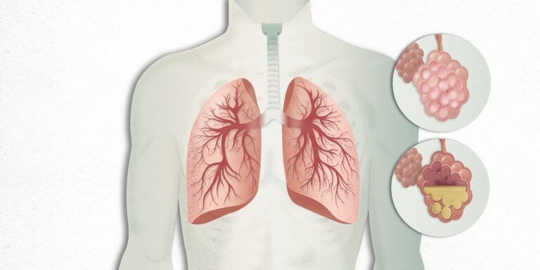 Pneumonia: Causes, Symptoms & Treatments - Ujala Cygnus