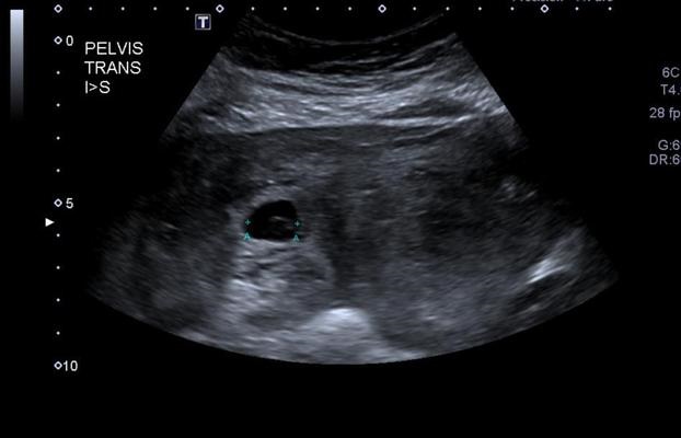 pregnancy-egg-rupture