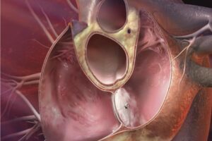 symptoms of hole in heart, signs and symptoms of hole in heart | Ujala ...