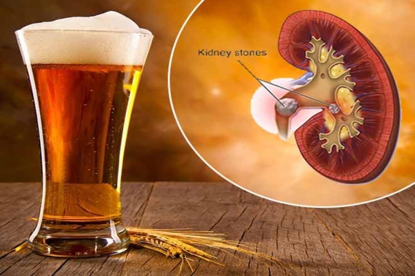 Beer Reduces Kidney Stone