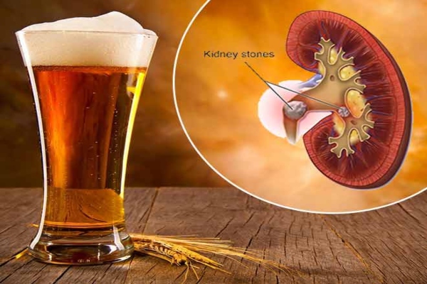 Is beer store good for kidney