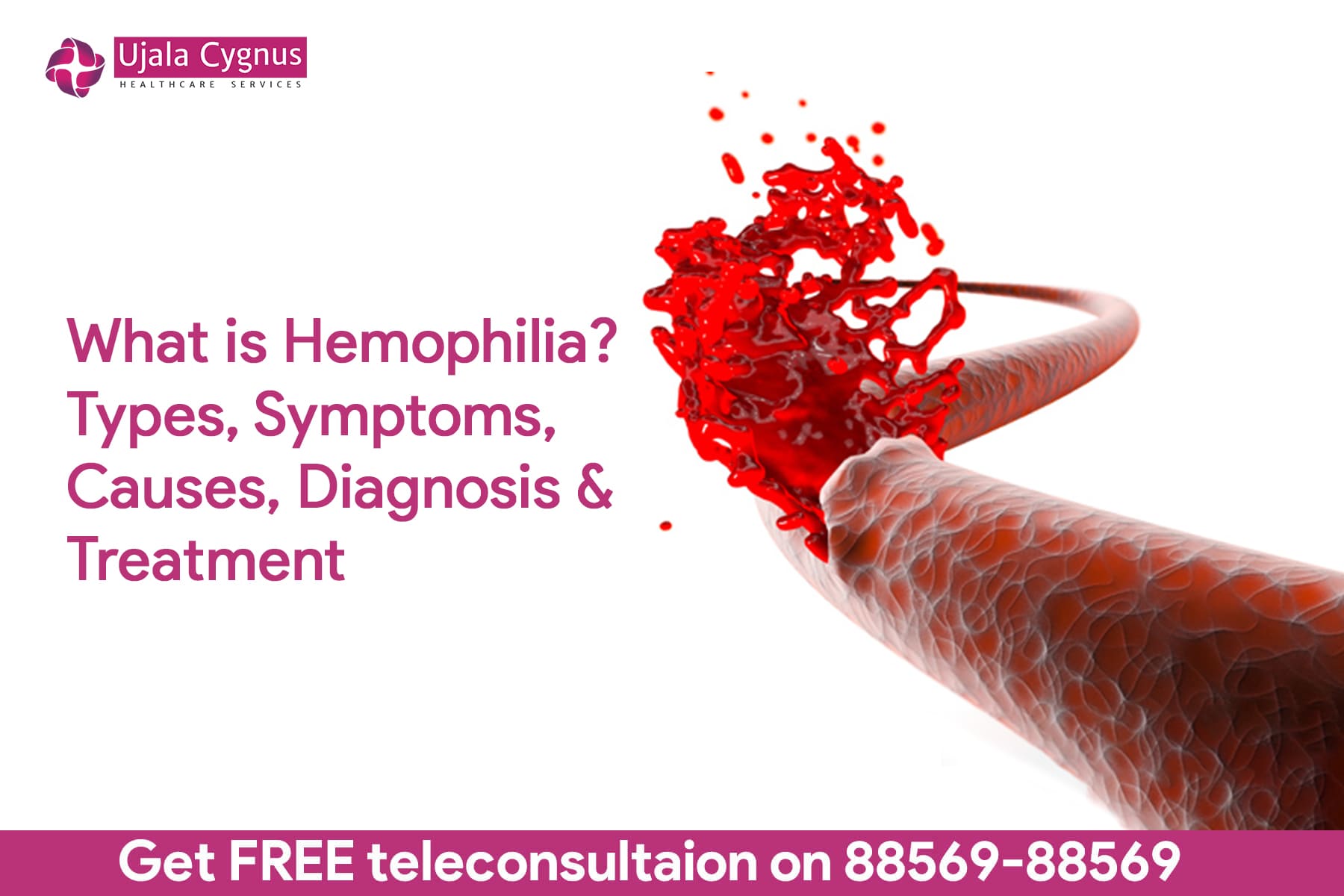 Hemophilia-Types, Symptoms, Causes, Diagnosis & Treatment