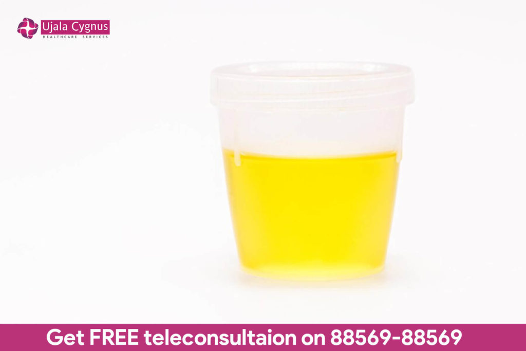 Yellow urine