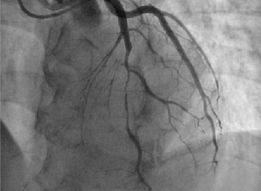 Angiography (CAG)