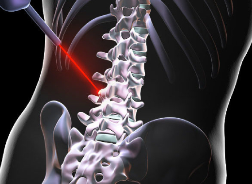 Spine Surgeries