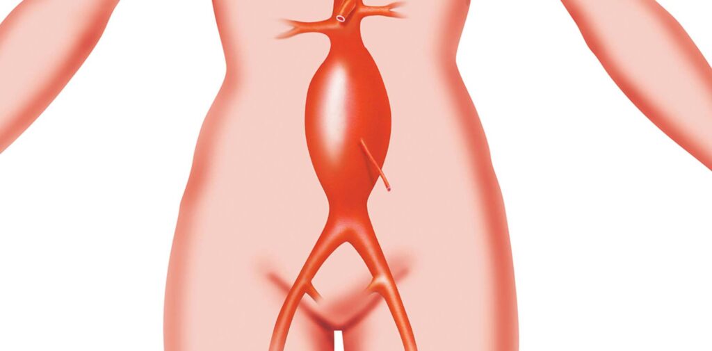 Know more about Abdominal Aortic Aneurysm