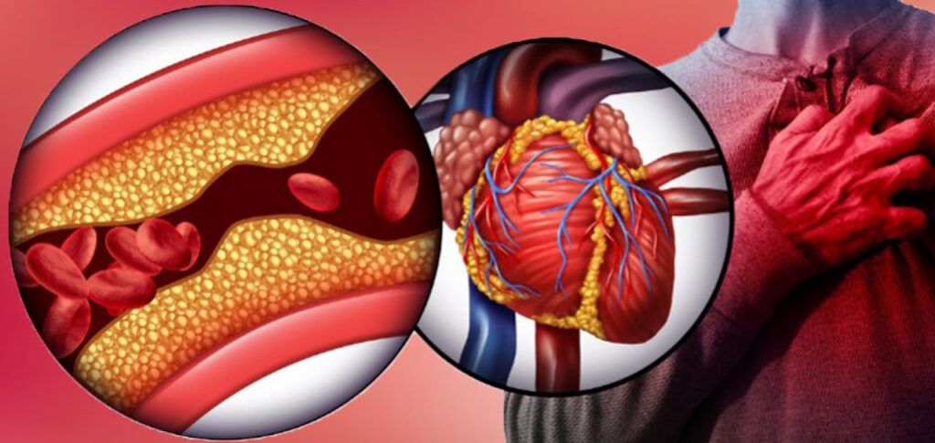 What is Coronary artery disease