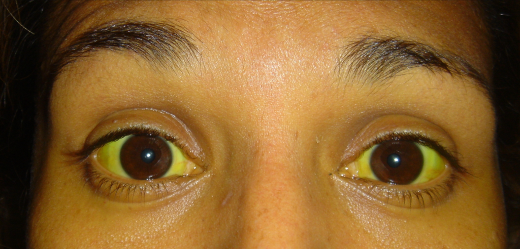 Symptoms of Jaundice: पीलिया रोग के 5 बड़े लक्षण |