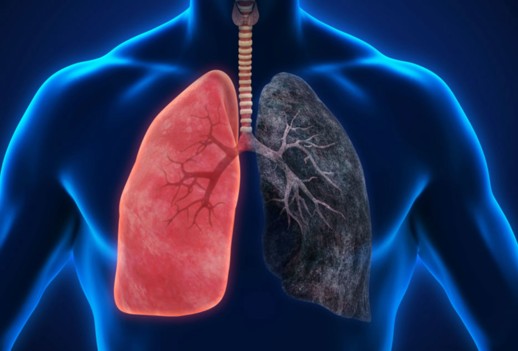 किसी भी उम्र में हो सकता है Lung Carcinoid Tumor, जानें इसके कारण और इलाज