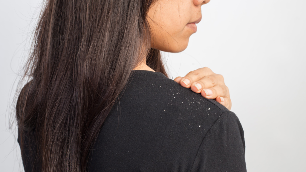 What Are The Different Types Of Dandruff?