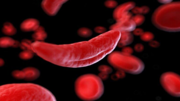 sickle-cell-anemia-770x436