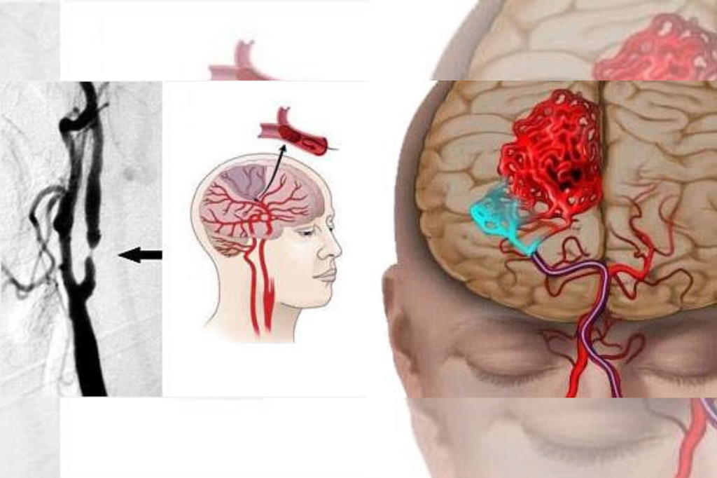 What is Brain Attack