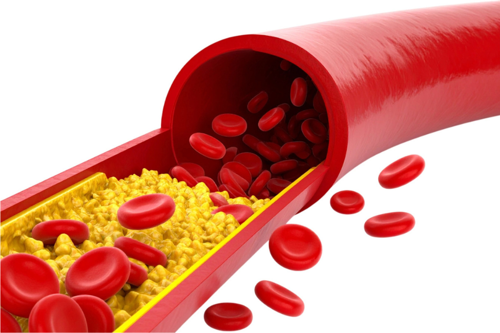 High Blood Pressure and High Cholesterol: Causes, Risks, and How to Control Them Naturally