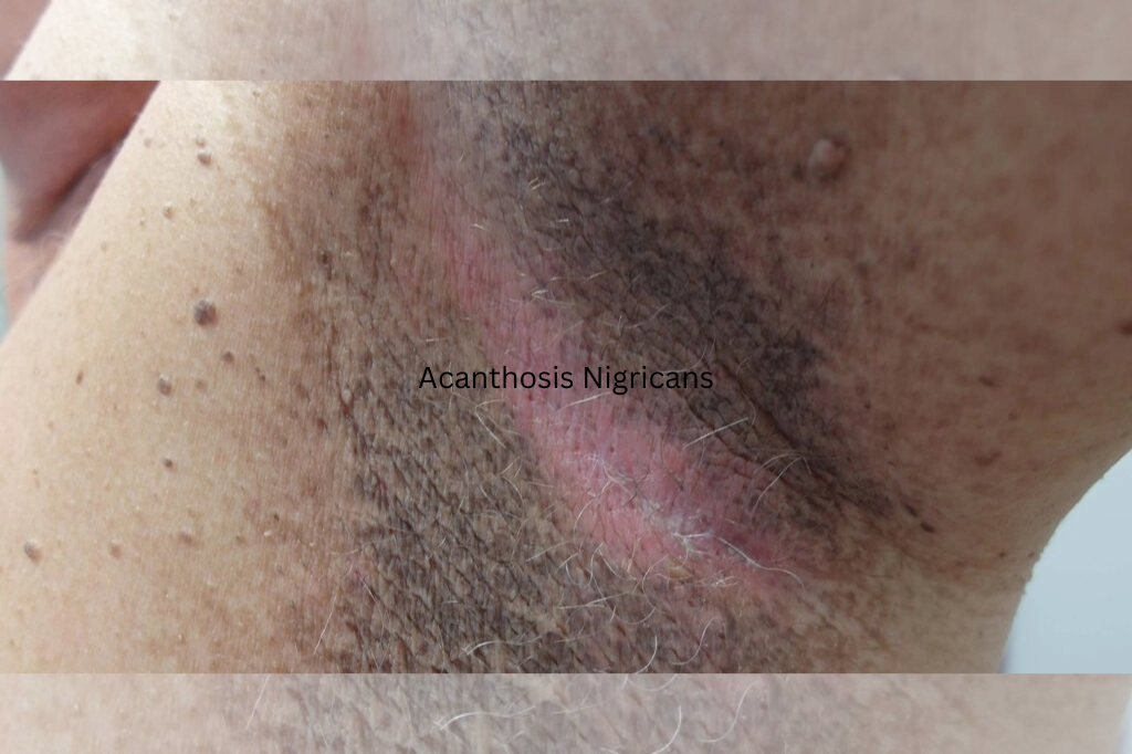 Acanthosis-Nigricans