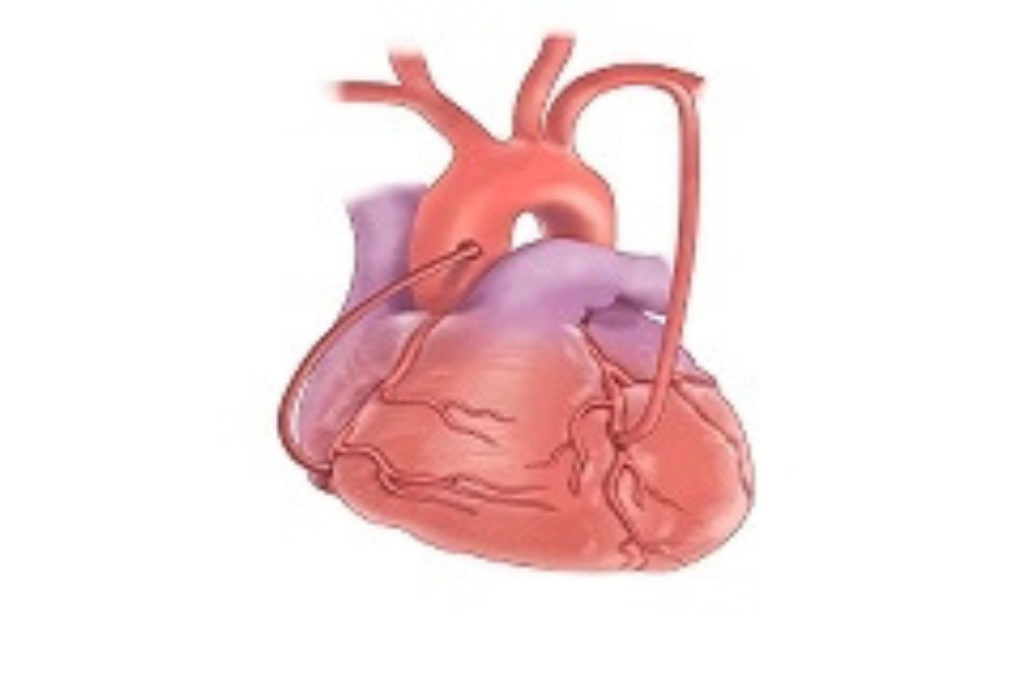 Overview Coronary artery bypass graft surgery (CABG) is a surgical procedure to restore blood flow to the areas of the heart. The surgery helps treat coronary artery disease, which causes the blood vessel to narrow due to the build-up of substances like fat and more in the coronary arteries. The narrowed blood vessels cannot properly supply oxygen-rich blood to the heart. The coronary artery bypass graft surgery is done to bypass the blocked portion of the artery so that the heart can receive oxygen-rich blood. Who Are the Best Candidates For CABG surgery? The doctor will decide whether the patient is a good candidate for the CABG surgery based on different factors, including The severity of coronary artery disease Location of the blockage in the arteries How many blockages does the patient have Patient&rsquo;s response to other treatments Quality of life The severity of the blockage of coronary arteries Who Should Not Consider CABG Surgery? Patients are not considered good candidates if they have the following conditions: Pre-existing heart conditions like heart valve disease Terminal illnesses like advanced cancer, liver failure Physical disability Bleeding disorder Unable to tolerate anaesthesia Kidney disease Peripheral arterial disease Diabetes How to Prepare for CABG Surgery The cardiac surgeon will talk in-depth about coronary artery bypass graft surgery and its benefits and potential risks. The doctor will advise particular instructions that must be followed before the surgery. Moreover, the surgeon will also conduct several tests to see whether it is safe for the patient to undergo surgery. These may include electrocardiogram, echocardiogram, stress test, X-ray, CT scan angiography, and blood tests. There are specific ways to prepare for the CABG surgery, including: Stop taking blood-thining medicines a few weeks before the surgery Quit smoking Avoid taking anti-inflammatory drugs Wear loose clothes to the hospital Don&rsquo;t eat heavy food the night before the surgery Drink clear liquids Make arrangements to stay in the hospital for several days Take all medications prescribed by the doctor before surgery How CABG Surgery Is Done The CABG is major surgery and is done as an in-patient hospitalization procedure. The surgery involves different steps. First, the patient is taken to the surgery room, and the medical team inserts intravenous (IV) lines to infuse medications and fluid through one of the veins. Next, general anaesthesia is administered, and the team also puts the patient on intubation and ventilation. The heart-lung bypass machine is used to take control of the lungs and heart during the surgery. The surgeon then makes a large incision at the centre of the chest and splits the breastbone down the middle to access the heart. Next, the surgeon takes a healthy blood vessel from the arms or thighs and crafts the bypass. The upper end of the bypass is attached to the aorta, and the lower end of the bypass is attached to the blocked artery just past the blockage. There are different techniques used for CABG surgery, including: In this procedure, the surgeon does not stop the heart and performs the surgery with the heart still beating. In this procedure, the coronary bypass is crafted through small incisions in the chest, usually with the help of robotics and video imaging. The surgery is also known as keyhole surgery. Possible Complications Just like every other significant surgery, CABG surgery also runs the risk of developing certain complications, including: Bleeding from the incision site Infection Memory loss Kidney problems Heart attack Swelling around incision Arrhythmias Stroke Damage to an organ or blood vessel Taking Care of Yourself After Surgery Patient undergoing CABG surgery usually takes several weeks to recover fully. The patients are kept in the intensive care unit for one or two days. The healthcare team provides detailed information about cardiac rehabilitation through various education programmes and exercises. The team will ask the patient to perform strenuous activities for a few weeks, exercise regularly, follow a healthy lifestyle and diet, manage stress, and more.