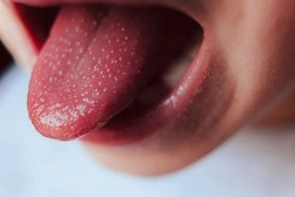 Kawasaki Disease