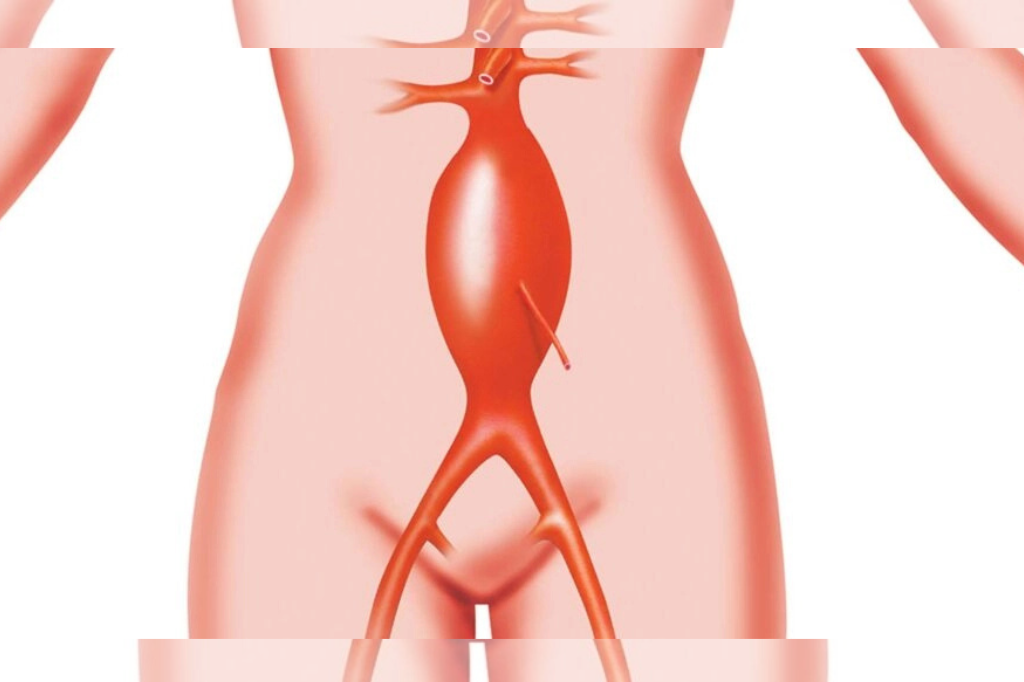 Know-more-about-Abdominal-Aortic-Aneurysm