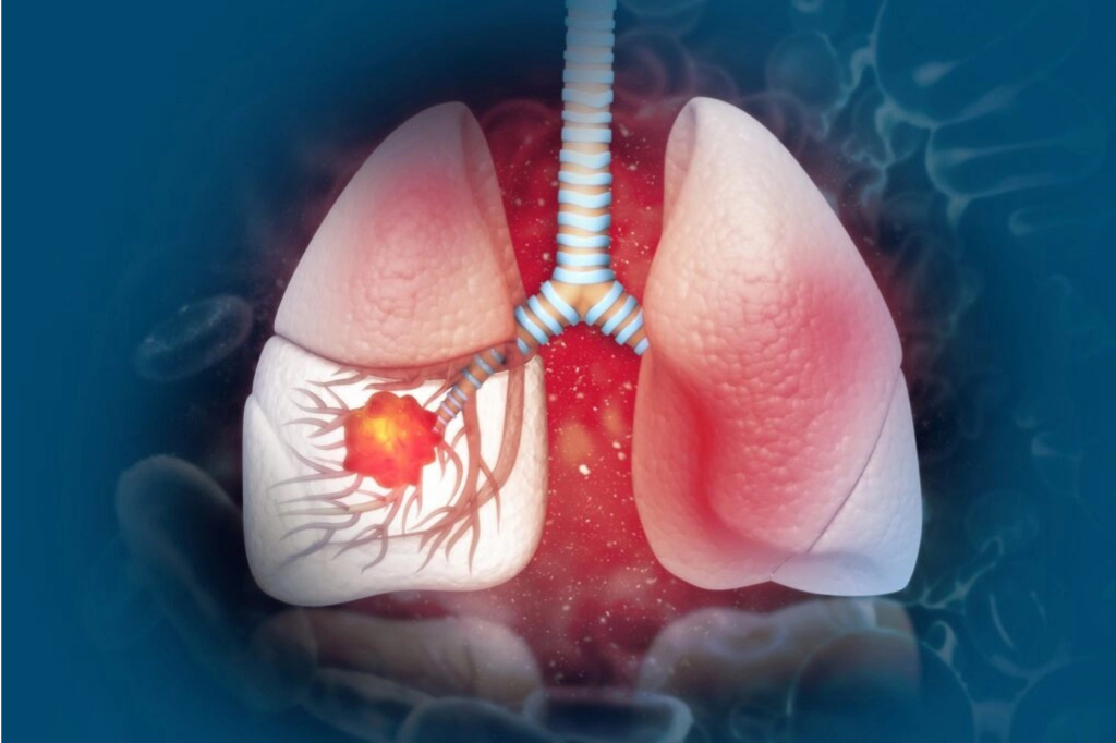 Lung-Cancer-Causes-Types-Diagnosis-Treatments