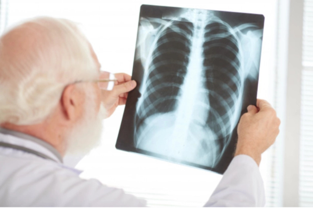 Tuberculosis- Symptoms, Types, Diagnosis & Treatment.