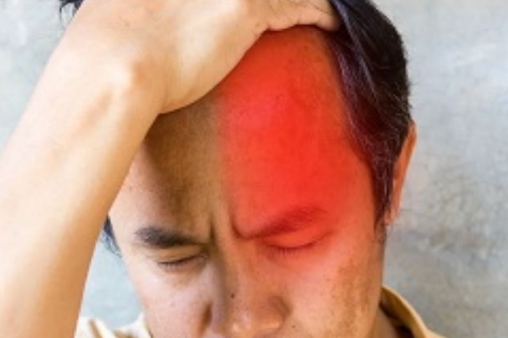cluster-headache