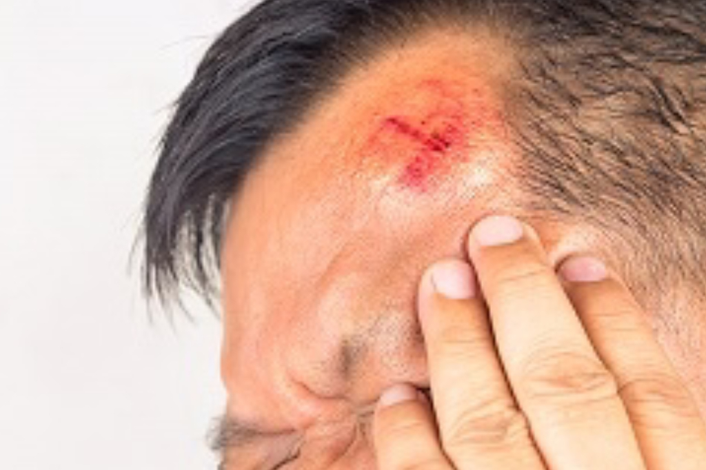 head-injury