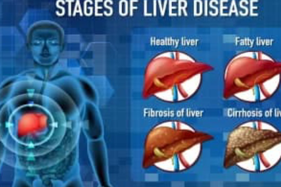 World Liver Day: क्या है नॉन एल्कोहोलिक फैटी लिवर, जानें इसके लक्षण व उपचार