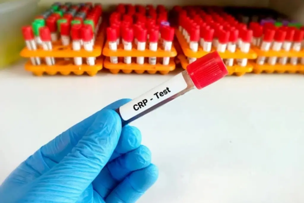 CRP-Test-What-High-C-Reactive-Protein-Levels-Mean-Common-Causes-and-Treatment.webp
