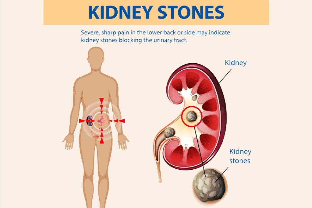 Kidney Stones: Know the Warning Signs Before They Become a Bigger Problem