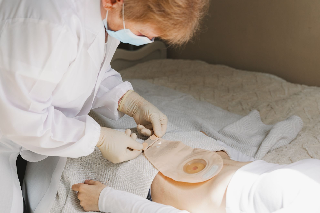 Living With a Stoma: Types, Daily Care, Diet & Recovery After Surgery
