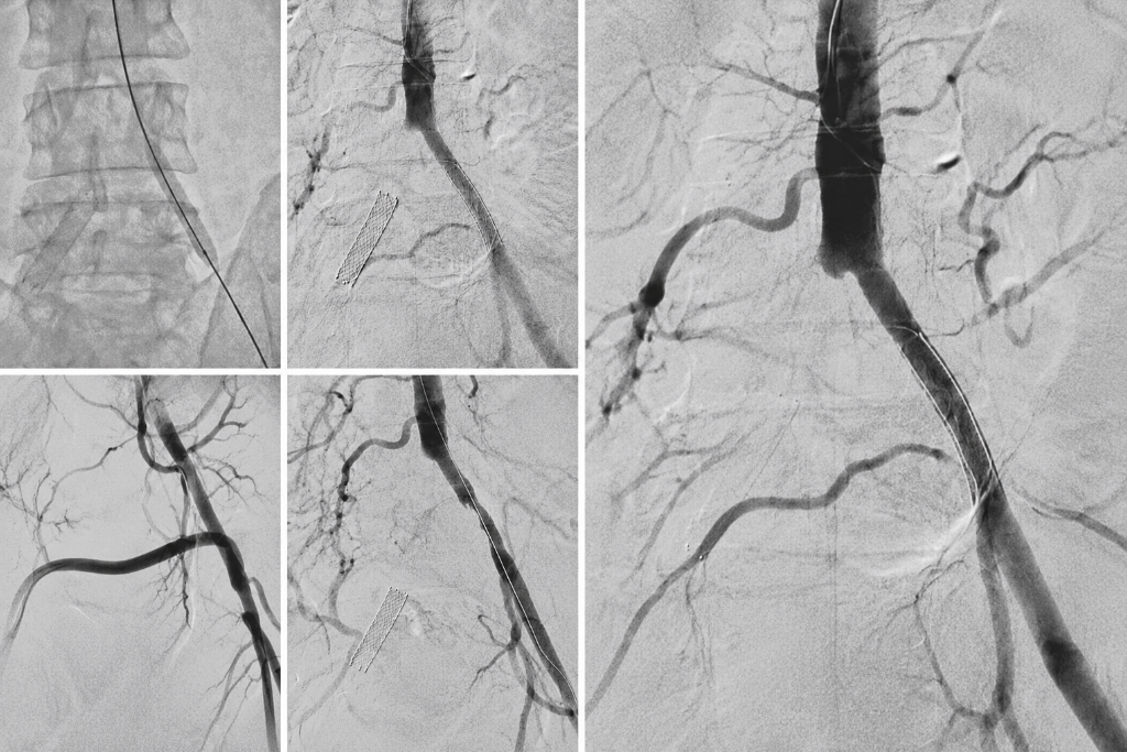 Restoring Pain-Free Mobility: Successful Angioplasty and Stenting for Severe Leg Pain at Ujala Cygnus Kashmir Superspeciality, Srinagar