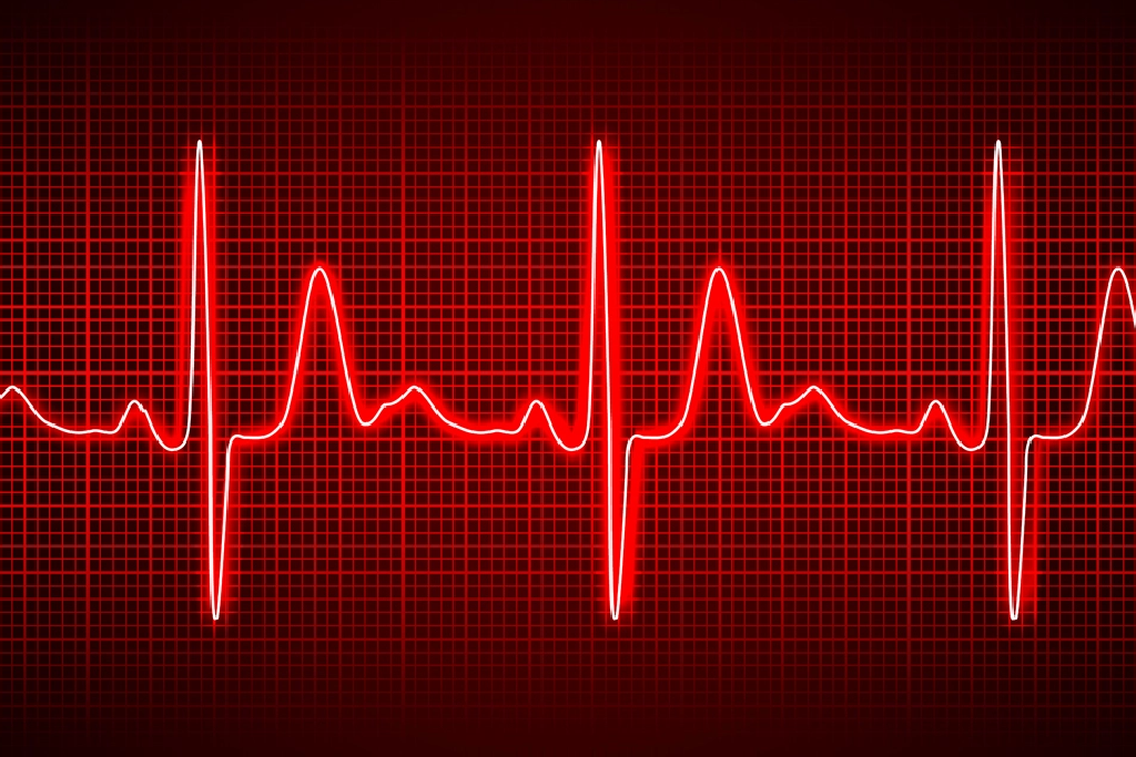 irregular-heartbeat-arrhythmia-img