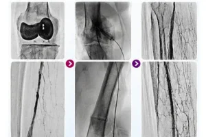 restoring-blood-flow-saving-a-limb_-successful-catheter-directed-thrombolysis-for-acute-limb-ischaemia-img