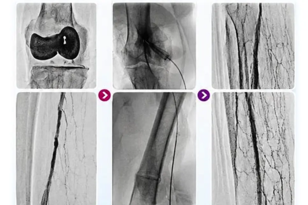 Restoring Blood Flow, Saving a Limb: Successful Catheter-Directed Thrombolysis for Acute Limb Ischaemia